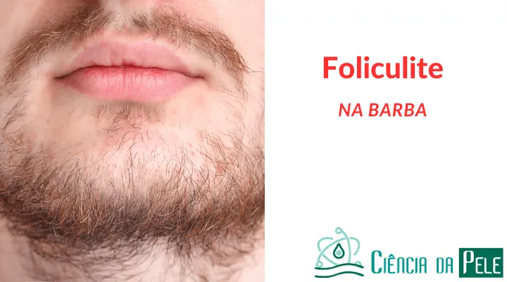 Foliculite na Barba: Prevenção e cuidados