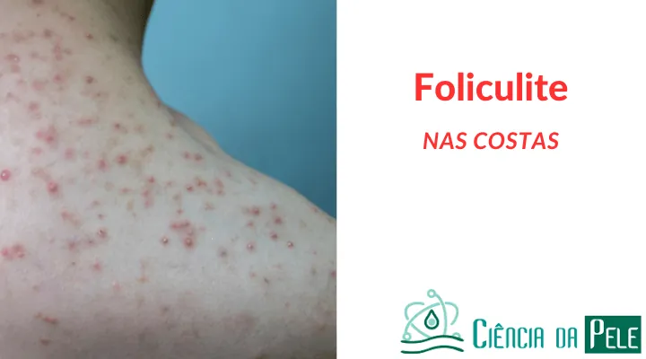 Foliculite nas costas: causas, sintomas e tratamentos