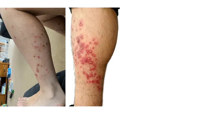 foliculite nas pernas