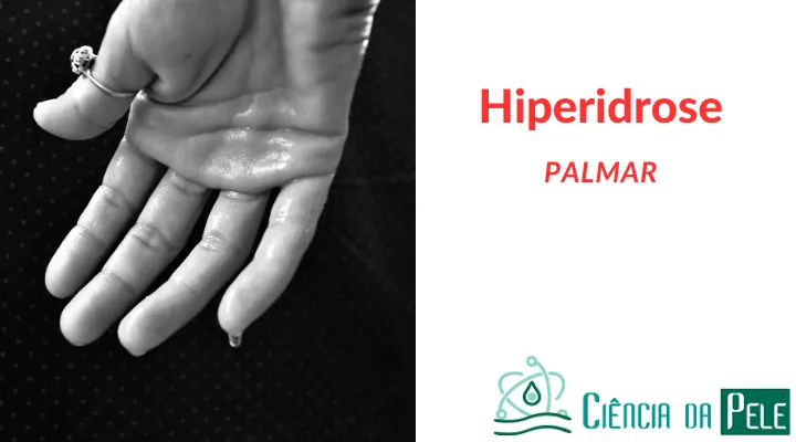Hiperidrose palmar: O que é e como tratar?