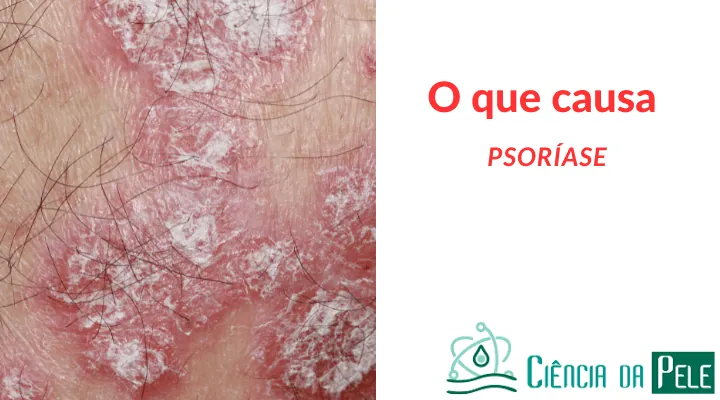 O que causa psoríase: descubra as principais causas