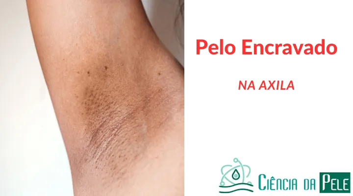 Pelo Encravado na Axila: Como Prevenir e Tratar