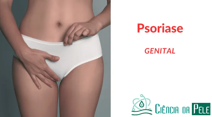 Psoríase Genital: Causas, Sintomas e Tratamentos