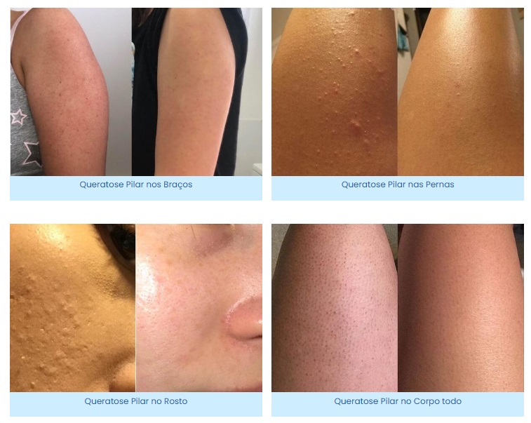 KP Solution antes e depois