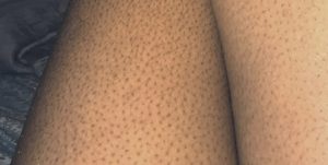 Queratose pilar em pele negra