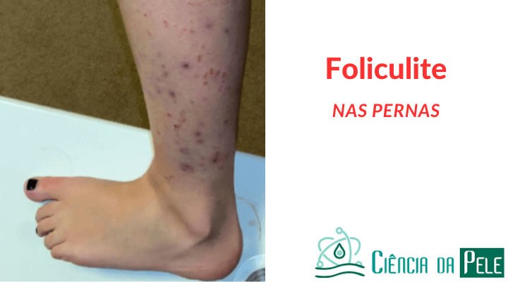 Foliculite nas pernas: causas, sintomas e tratamentos