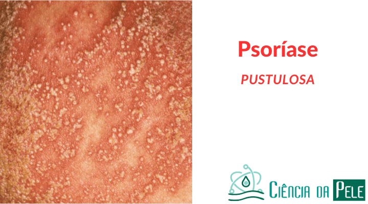 Psoríase Pustulosa: Sintomas e Tratamentos