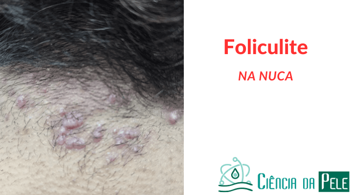 Foliculite na Nuca: Sintomas e Tratamentos