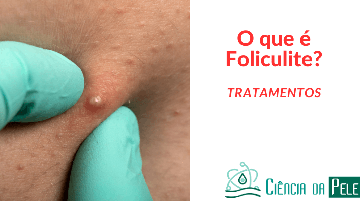 O que é foliculite: Causas, sintomas e tratamentos